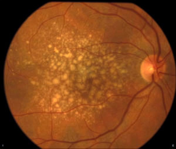 revoptom's tweet image. AMD Patients Carrying Rare Gene Variants Predisposed to GA

Subjects in a recent study were significantly more likely to present with soft indistinct drusen, reticular pseudodrusen, larger drusen size and macular involvement.
reviewofoptometry.com/news/article/a…
#AMD #optometry