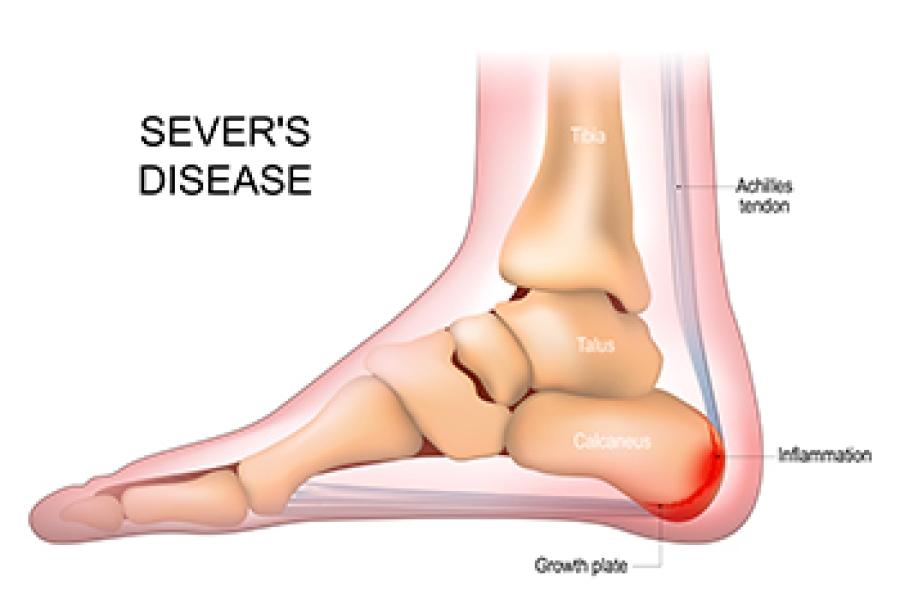 Understanding Sever’s Disease dlvr.it/TRpJSY