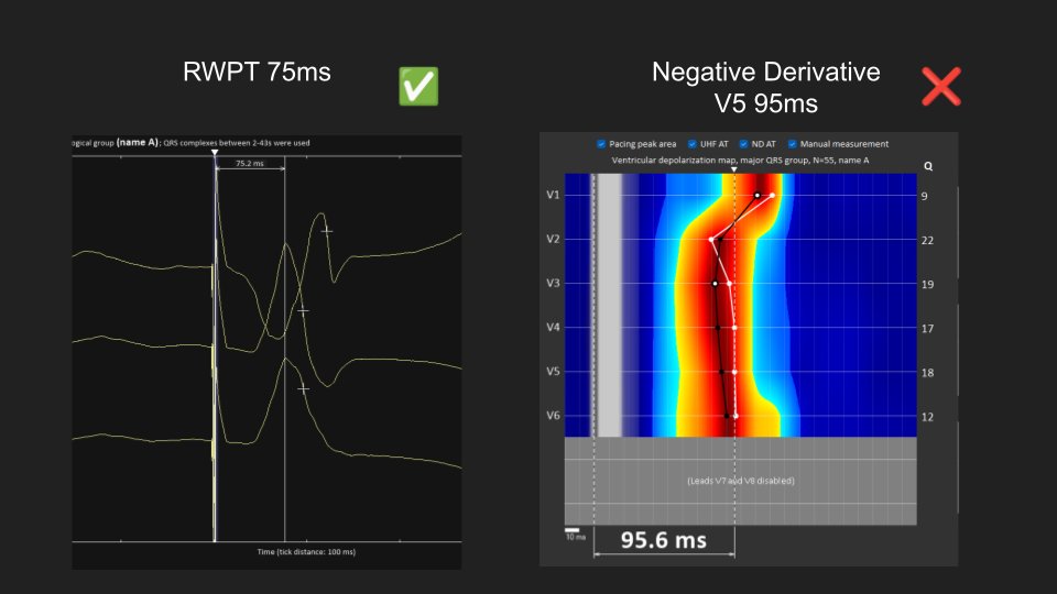 MirekNavratil1's tweet photo. RWPT can be falsely short when the distal septum is paced. A negative derivative (dV/dt) can help resolve the ambiguity in such cases. You can capture the UHF map to confirm. https://t.co/jCKo9G1bsh