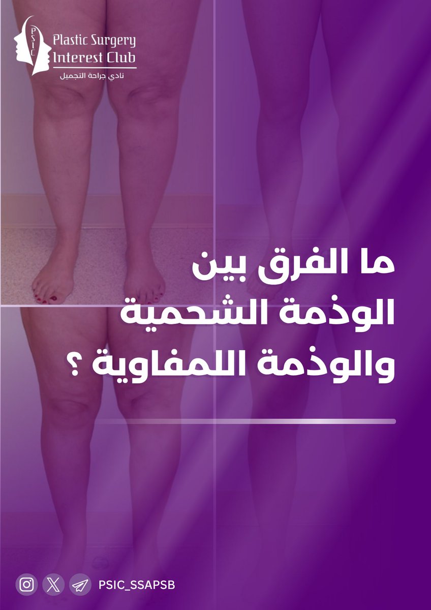 PSIC_SSAPSB's tweet photo. مو كل تورّم واحد! ⚠️
الفرق بين الوذمة الشحمية والوذمة اللمفاوية مهم للتشخيص والعلاج 🩺

تعرّف على الاختلافات 👇 https://t.co/KCTVwUgyiF