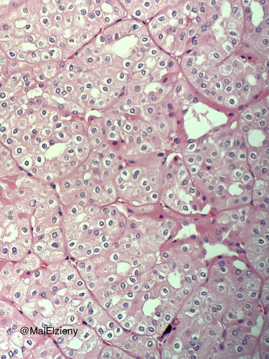 MaiElzieny's tweet image. Same kidney 
2 tumors in 2 different locations 
2 diagnosis! No IHC needed.
#PathTwitter 
#PathX