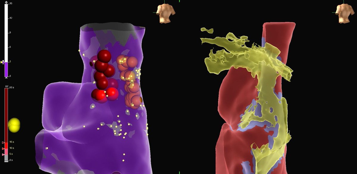sumitvermaep's tweet photo. CNA for a young patient with recurrent asystole. SVC-Ao, LSGP, MTGP ablated. Fat pad localization with #InHeart. Frequency mapping with #AbbottCardio #ESI https://t.co/r9GucKkeCs