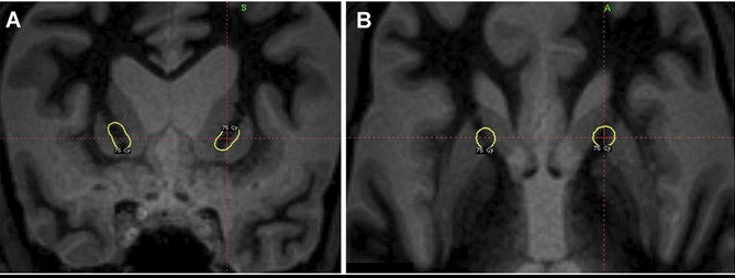 jasonpsheehan's tweet photo. SRS targeting for treatment of severe OCD from the latest guidelines by the ISRS published in Neurosurgery. https://t.co/uXlKkNIu6I
