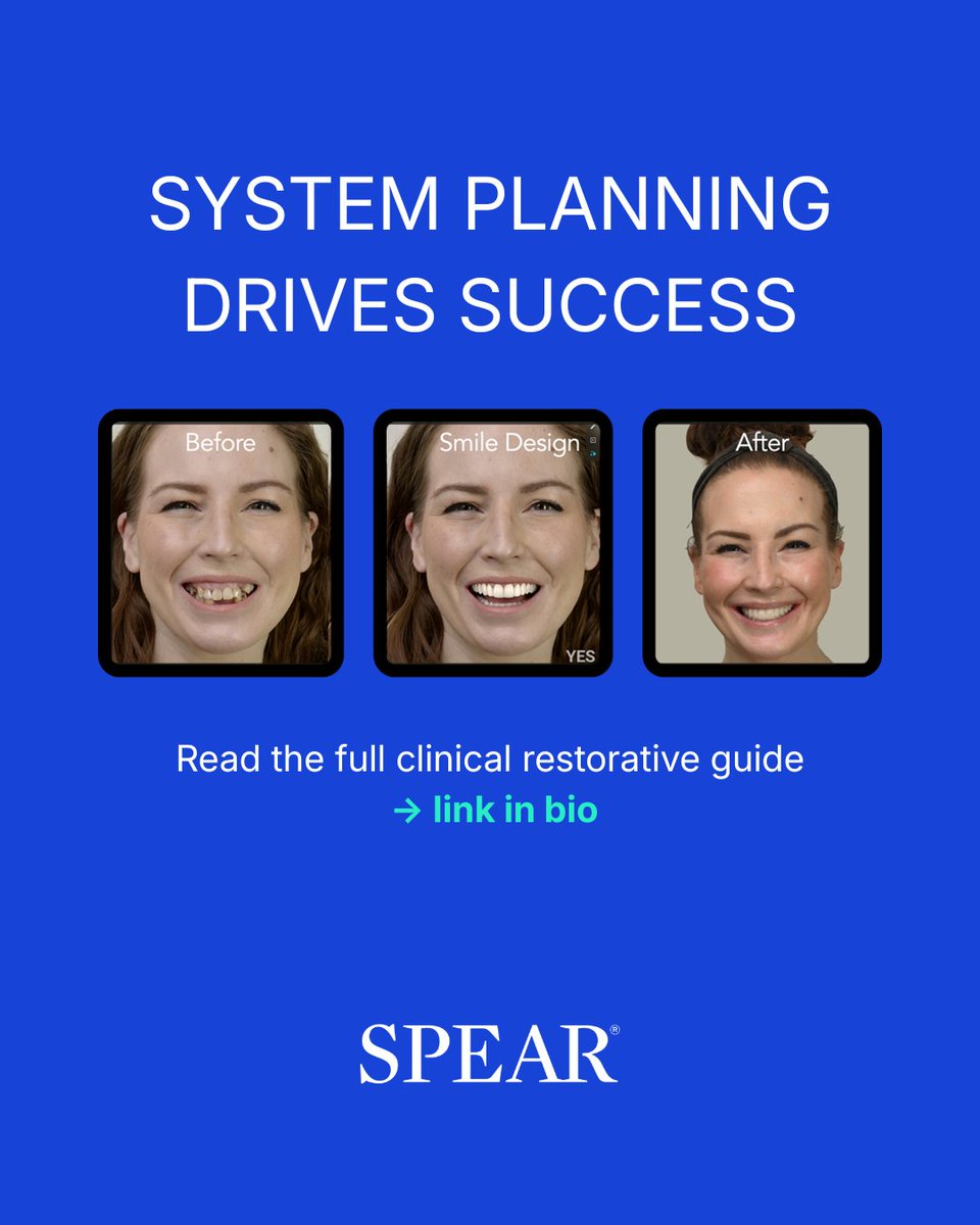 SpearEducation's tweet photo. Most All-on-X failures start before surgery. 

If biomechanics, FP design, and load distribution are off in planning, surgery just exposes it. 

Same surgeon. Different outcomes.

Full guide → https://t.co/k44I7vGDph https://t.co/NZV4ZvKfRS