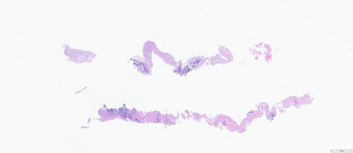 slusagar's tweet image. #GUpath prostate bx #beautyinb9:
😍typical glandular🔬&amp;amp; secretions from verumontanum