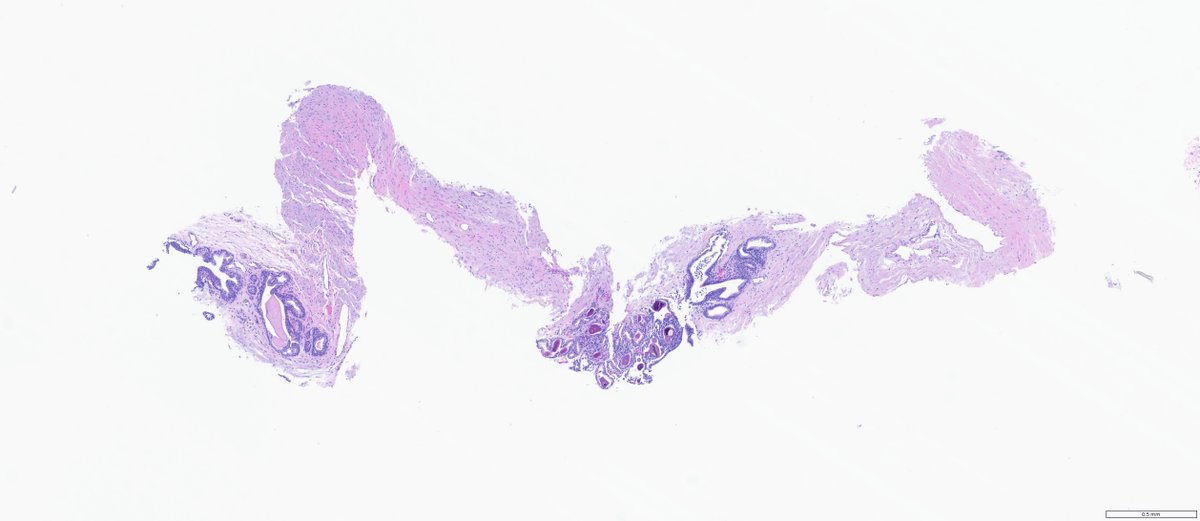slusagar's tweet image. #GUpath prostate bx #beautyinb9:
😍typical glandular🔬&amp;amp; secretions from verumontanum