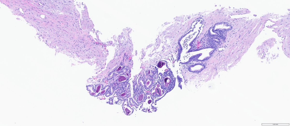 slusagar's tweet image. #GUpath prostate bx #beautyinb9:
😍typical glandular🔬&amp;amp; secretions from verumontanum