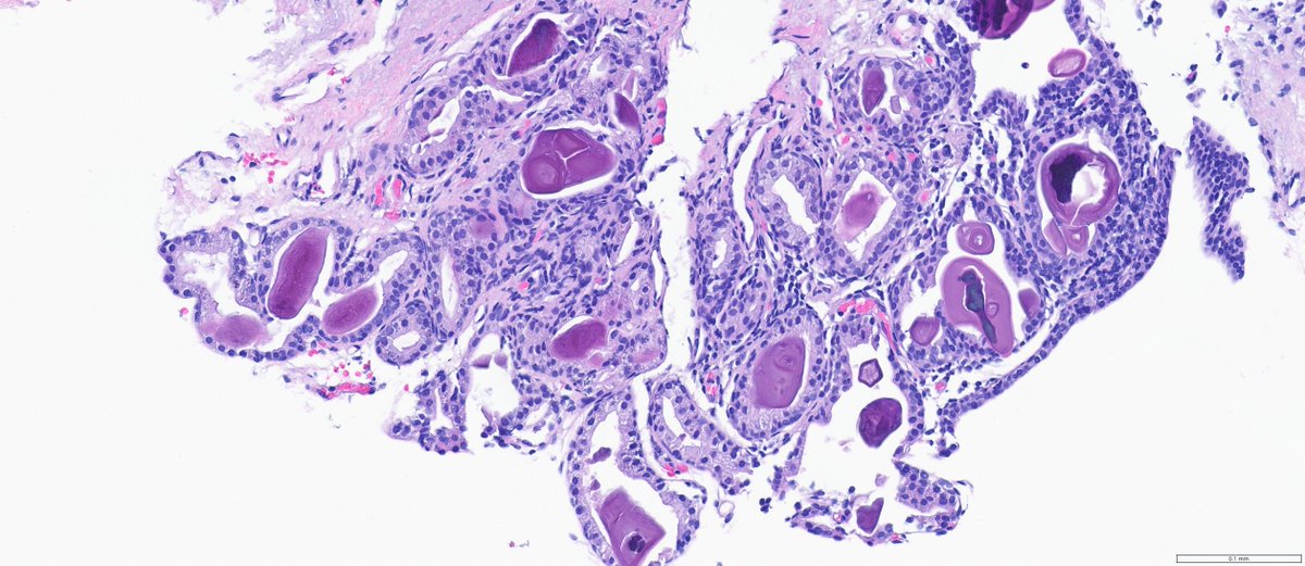 slusagar's tweet image. #GUpath prostate bx #beautyinb9:
😍typical glandular🔬&amp;amp; secretions from verumontanum