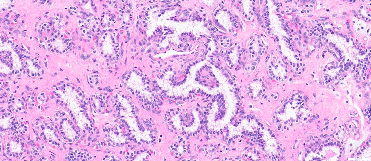 slusagar's tweet image. #GUpath nephrectomy:

Dx: clear cell papillary renal cell tumor
(I wish they'd named it clear cell TUBULOPAPILLARY renal tumor to emphasize morph!)

here,😍example of "shark smile" (tubulopapillary morph)🔬, as some cases lack prominent "reverse-apical" nuclei!