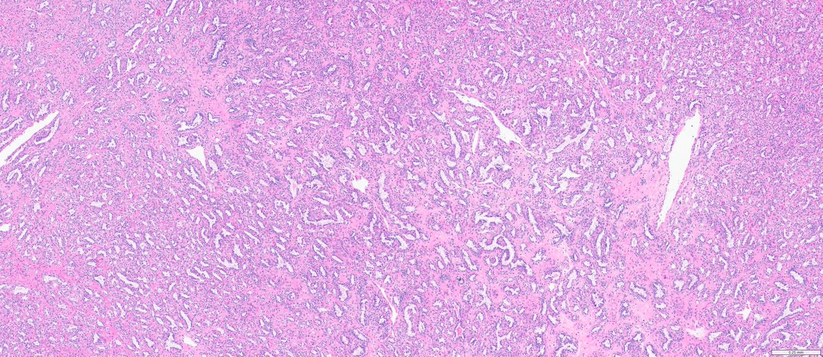slusagar's tweet image. #GUpath nephrectomy:

Dx: clear cell papillary renal cell tumor
(I wish they'd named it clear cell TUBULOPAPILLARY renal tumor to emphasize morph!)

here,😍example of "shark smile" (tubulopapillary morph)🔬, as some cases lack prominent "reverse-apical" nuclei!