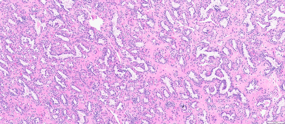 slusagar's tweet image. #GUpath nephrectomy:

Dx: clear cell papillary renal cell tumor
(I wish they'd named it clear cell TUBULOPAPILLARY renal tumor to emphasize morph!)

here,😍example of "shark smile" (tubulopapillary morph)🔬, as some cases lack prominent "reverse-apical" nuclei!
