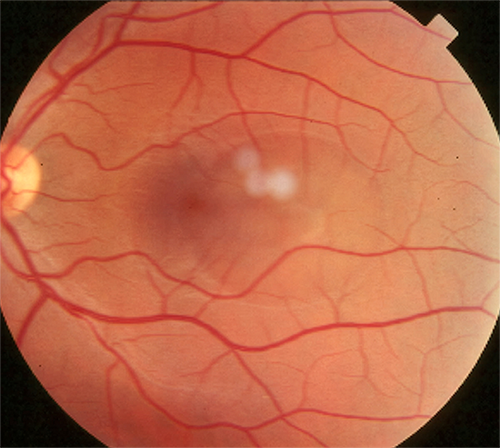 revoptom's tweet image. During Eight-year Follow-Up, More than Half of CSCR Cases Experience Recurrence

Longer total subretinal fluid duration and CNV development were associated with worse visual prognosis.
reviewofoptometry.com/article/during…

#optometry #retina