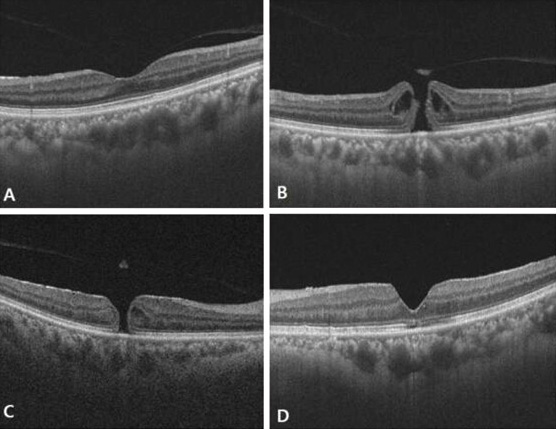 revoptom's tweet image. Short Axial Length Increases Likelihood of Fellow-eye Idiopathic Macular Hole

New research suggests that measuring this parameter in unilateral cases may help identify patients at higher risk.
reviewofoptometry.com/article/short-…

#retina #optometry #macularhole