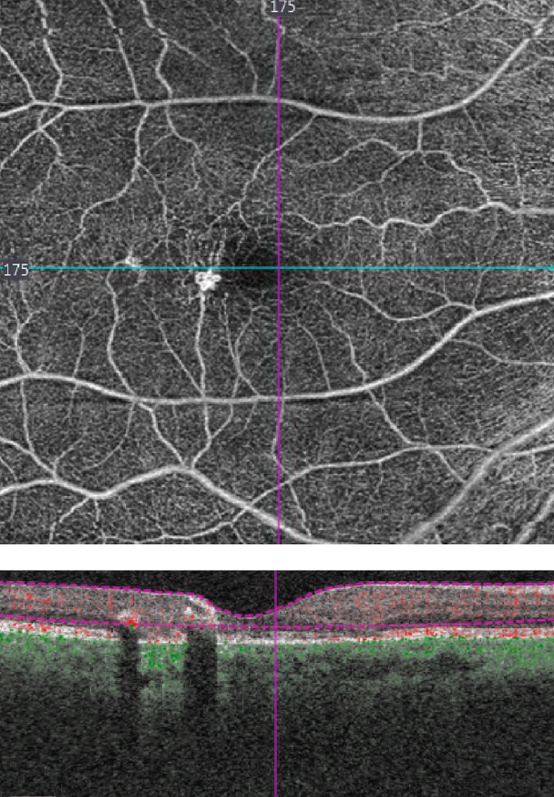 revoptom's tweet image. Ciliary Neurotrophic Factor Drug Well-tolerated in MacTel Patients

This treatment appears to slow retinal degeneration and preserve visual function, but further trials are needed to fully characterize its functional impact.
reviewofoptometry.com/article/ciliar…

#retina #optometry #mactel2