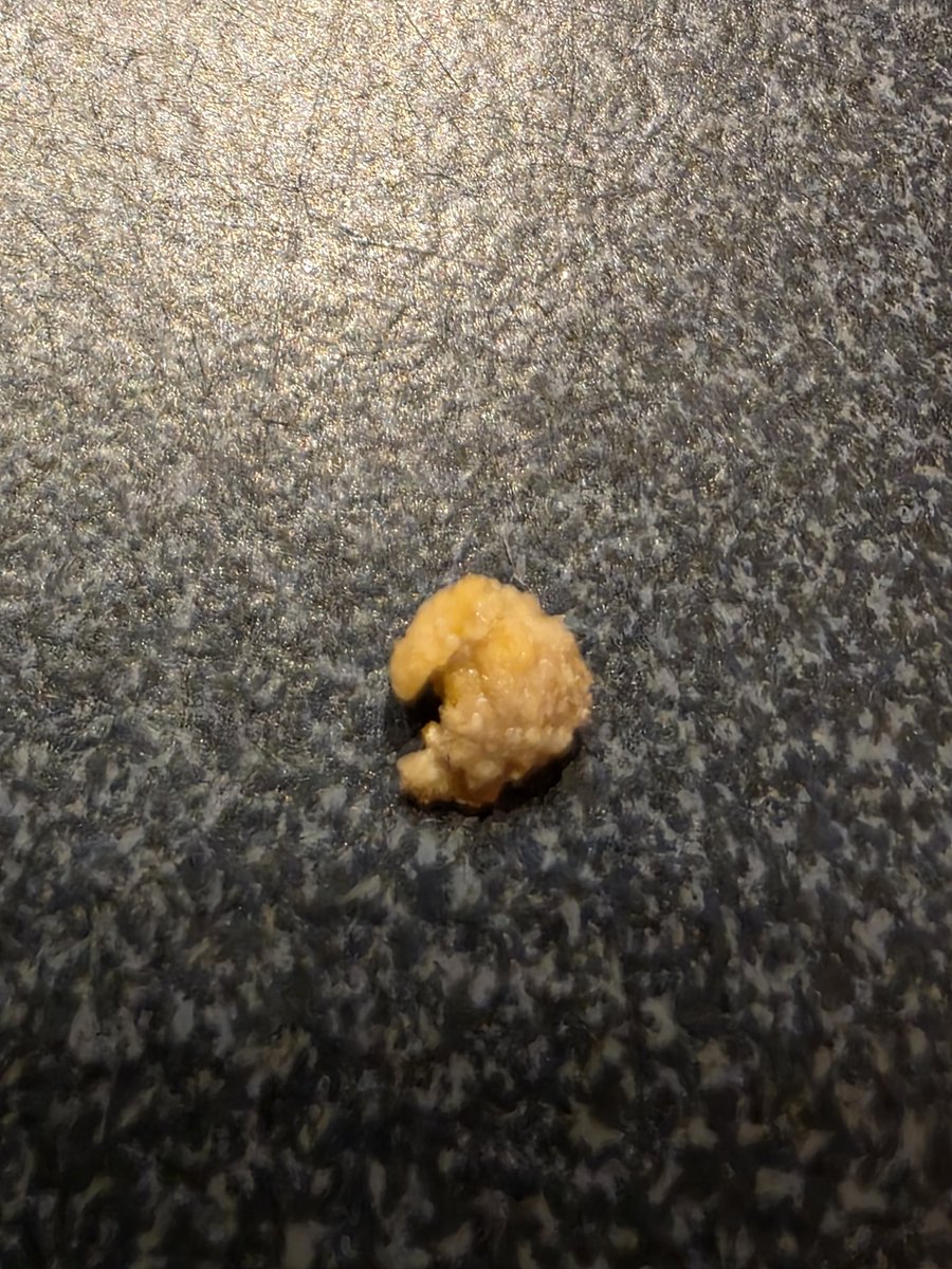 Who else loves kidney stones? 💪🤣 little bastard