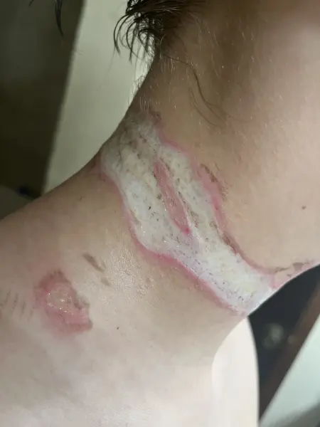 This kid survived a near fatal electrocution....
Do you see the chain melting into the skin...
Would burn your shirt, would be noticeable HUGE!! 

Anyone with common sense...know this didnt happen to Charlie...Dont drink the kool-aid folks!!! 
Charlies chain flew out behind him,