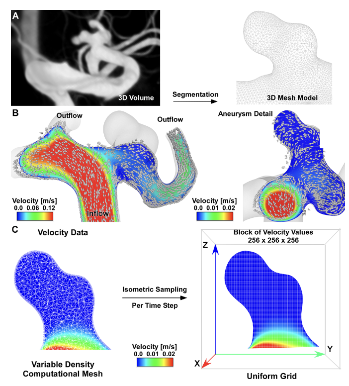 TheJNS's tweet image. #OnlineFirst: A novel application of radiomics analysis for the evaluation of intradome transient velocity in cerebral aneurysms. 

thejns.org/view/journals/….