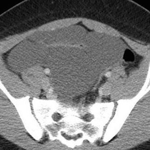 RadiologyACR's tweet image. 📖 #RadExam Study Guide 📖

A CT with intravenous contrast was obtained in a 12-year-old girl with abdominal pain. What is the most likely diagnosis? 

A) Small bowel obstruction 
B) Ovarian cystadenoma  
C) Lymphatic malformation
D) Ileal duplication cyst