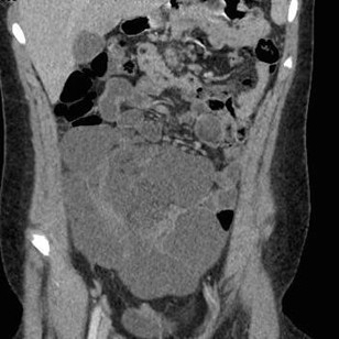 RadiologyACR's tweet image. 📖 #RadExam Study Guide 📖

A CT with intravenous contrast was obtained in a 12-year-old girl with abdominal pain. What is the most likely diagnosis? 

A) Small bowel obstruction 
B) Ovarian cystadenoma  
C) Lymphatic malformation
D) Ileal duplication cyst