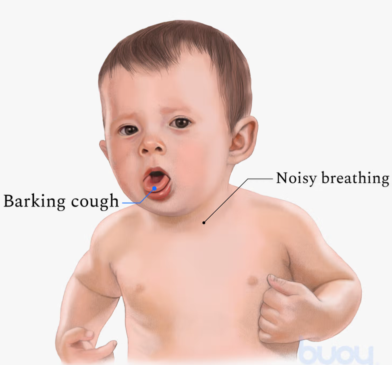ICUDecoded's tweet photo. Q-24
A child presents with barking cough and inspiratory stridor. Most likely diagnosis?

A. Asthma
B. Pneumonia
C. Croup
D. Bronchiolitis

@ICUDecoded FOLLOW for more https://t.co/uT9JmuSi9k