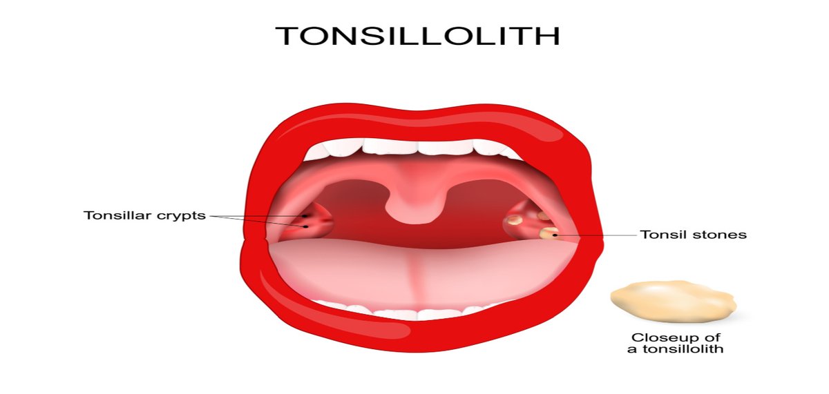 PositivemindH's tweet image. Post by Dr Sagar Rajkuwar – ENT Specialist Doctor, Nashik, India

😷 White patches on tonsils? It may be tonsillitis—don’t ignore symptoms.

📖 Full medical explanation here 👇
 healthuseful.com/tonsillitis-wh…

#Tonsillitis #ENTDoctor #HealthTips #ThroatInfection #Awareness