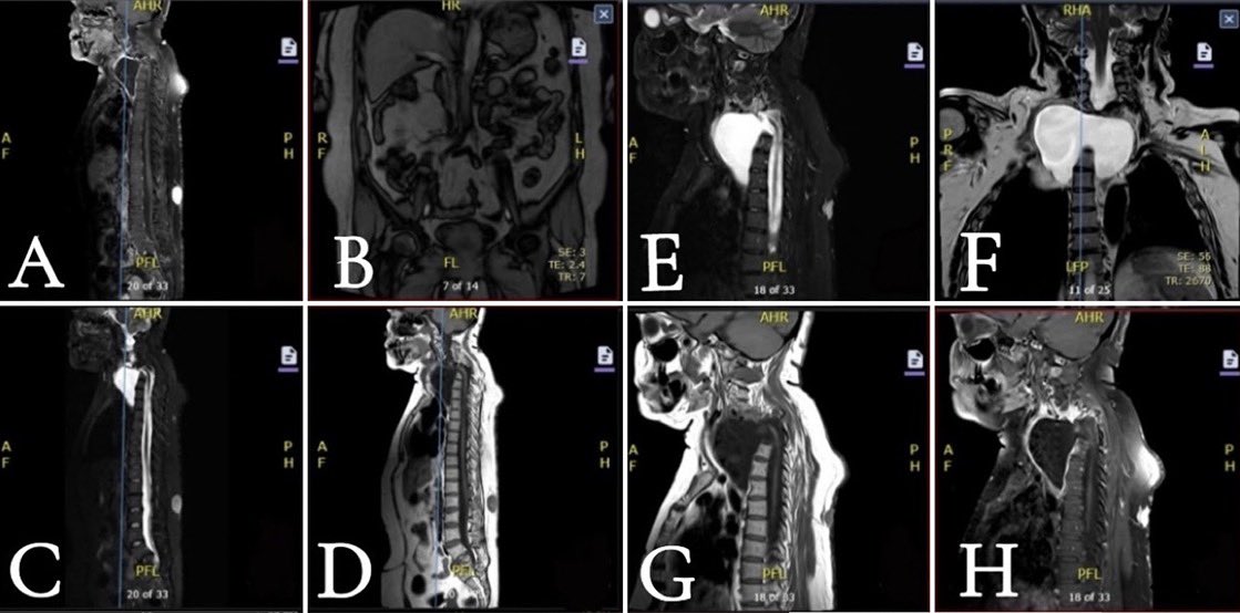 badr_hafiz_'s tweet photo. I’m happy to share our recent publication in the Journal of Neurosurgery: Case Lessons @TheJNS, the official journal of @AANSNeuro 

“Progressive cervicothoracic meningocele with neurovascular compression and spinal deformity in neurofibromatosis type 1: A decade-long radiological and clinical evolution with operative repair – Illustrative case”

🔗Link: https://t.co/aBMY1KnQin

Key insights from our work:

🔹 Spinal meningoceles in NF1 can remain indolent for years before causing significant neurological and neurovascular compromise, l ong-term surveillance is critical

🔹 Cervical involvement, though rare, can lead to severe deformity, airway/esophageal compression, and vascular displacement. 

🔹 Timely surgical intervention with a carefully planned anterolateral approach can result in meaningful clinical and radiological improvement. 

This case underscores the importance of multidisciplinary management in NF1 and highlights the challenges of decision-making in complex spinal pathology.

Grateful to my mentor @drmaref for his continuous guidance and support.

@AhmedHafezMousa 
@alaanabil2 
@Tala_AlSindi 

#Neurosurgery #SpineSurgery #Cervicalspine #Necksurgery #Neurofibromatosis #MedicalResearch #CaseReport #NeuroOncology #CaseLessons #JNS #AANS #NF1
