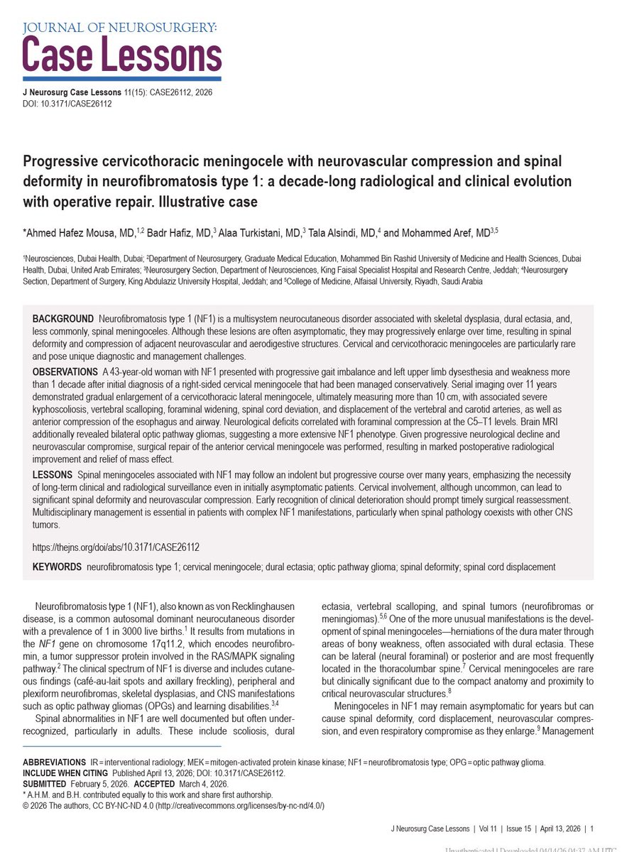 badr_hafiz_'s tweet photo. I’m happy to share our recent publication in the Journal of Neurosurgery: Case Lessons @TheJNS, the official journal of @AANSNeuro 

“Progressive cervicothoracic meningocele with neurovascular compression and spinal deformity in neurofibromatosis type 1: A decade-long radiological and clinical evolution with operative repair – Illustrative case”

🔗Link: https://t.co/aBMY1KnQin

Key insights from our work:

🔹 Spinal meningoceles in NF1 can remain indolent for years before causing significant neurological and neurovascular compromise, l ong-term surveillance is critical

🔹 Cervical involvement, though rare, can lead to severe deformity, airway/esophageal compression, and vascular displacement. 

🔹 Timely surgical intervention with a carefully planned anterolateral approach can result in meaningful clinical and radiological improvement. 

This case underscores the importance of multidisciplinary management in NF1 and highlights the challenges of decision-making in complex spinal pathology.

Grateful to my mentor @drmaref for his continuous guidance and support.

@AhmedHafezMousa 
@alaanabil2 
@Tala_AlSindi 

#Neurosurgery #SpineSurgery #Cervicalspine #Necksurgery #Neurofibromatosis #MedicalResearch #CaseReport #NeuroOncology #CaseLessons #JNS #AANS #NF1