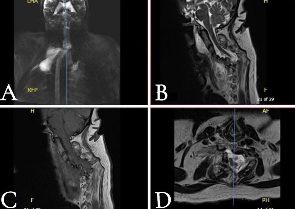 badr_hafiz_'s tweet photo. I’m happy to share our recent publication in the Journal of Neurosurgery: Case Lessons @TheJNS, the official journal of @AANSNeuro 

“Progressive cervicothoracic meningocele with neurovascular compression and spinal deformity in neurofibromatosis type 1: A decade-long radiological and clinical evolution with operative repair – Illustrative case”

🔗Link: https://t.co/aBMY1KnQin

Key insights from our work:

🔹 Spinal meningoceles in NF1 can remain indolent for years before causing significant neurological and neurovascular compromise, l ong-term surveillance is critical

🔹 Cervical involvement, though rare, can lead to severe deformity, airway/esophageal compression, and vascular displacement. 

🔹 Timely surgical intervention with a carefully planned anterolateral approach can result in meaningful clinical and radiological improvement. 

This case underscores the importance of multidisciplinary management in NF1 and highlights the challenges of decision-making in complex spinal pathology.

Grateful to my mentor @drmaref for his continuous guidance and support.

@AhmedHafezMousa 
@alaanabil2 
@Tala_AlSindi 

#Neurosurgery #SpineSurgery #Cervicalspine #Necksurgery #Neurofibromatosis #MedicalResearch #CaseReport #NeuroOncology #CaseLessons #JNS #AANS #NF1