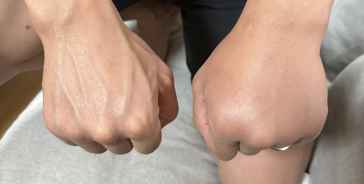試合始まって1分くらいでジャブ打った時に硬いところに当たったみたいで、
ヤバい！折れた！と思った左手
クリームパンみたいにパンパンやけど骨は無事でよかった

しかしまた鼻の骨が...
折れるの何回目だよ
５回目くらいかな