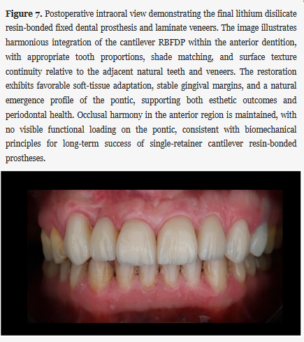 🦷 New in Prosthesis: "Minimally Invasive Rehabilitation of a Missing Maxillary Lateral Incisor Using a Lithium Disilicate Cantilever Resin-Bonded Prosthesis: A Clinical Case Report"

by Toras et al.

🔓 #Open_Access, free to read at: brnw.ch/21x1zgF

#Prosthetics