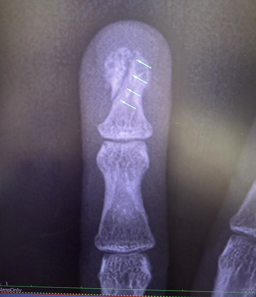 ひとみ🌈ひとじゅんレズビアンカップル tweet media