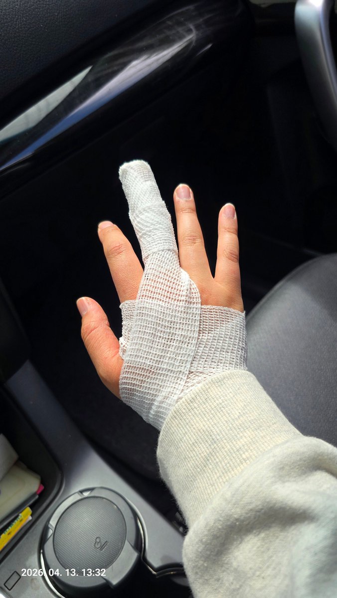 그리고 근황.
회사 근무 도중에 기계에 손가락이 끼어 부상을 당한 상태..
엑스레이상으론 실금이 보인다는데
붓기가 가라앉고 목요일에 다시 보기로.
어제는 조퇴, 오늘은 쉼.