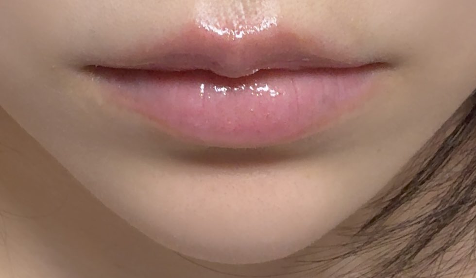 ギャルネコ 脂肪注入DT tweet media