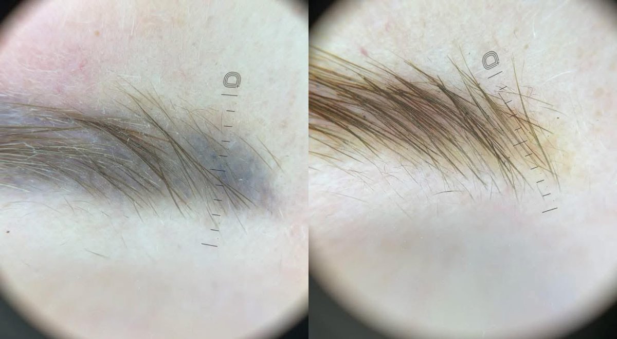 DoctorUskov's tweet image. Proper permanent makeup removal with pico- and nanosecond lasers is not only about pigment clearance.

When performed correctly, it preserves follicular structures and can support healthier natural eyebrow regrowth.

#uskovprotocol #pmuremoval #eyebrows #lasertreatment