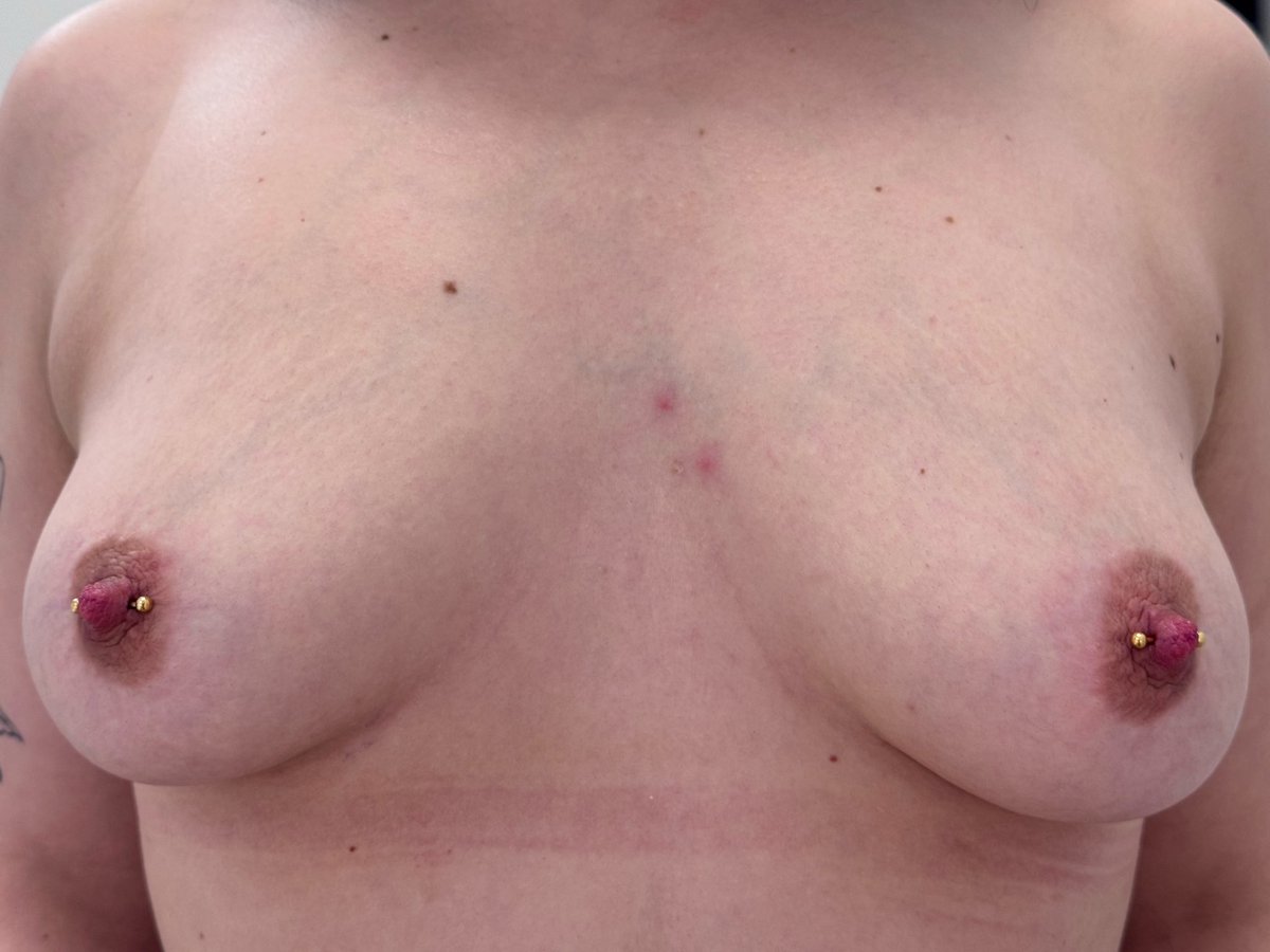 STERYLPIERCING's tweet photo. Nipple piercings done at guestspot at Zagreb 💥 book yours https://t.co/5mtfvqbaQc