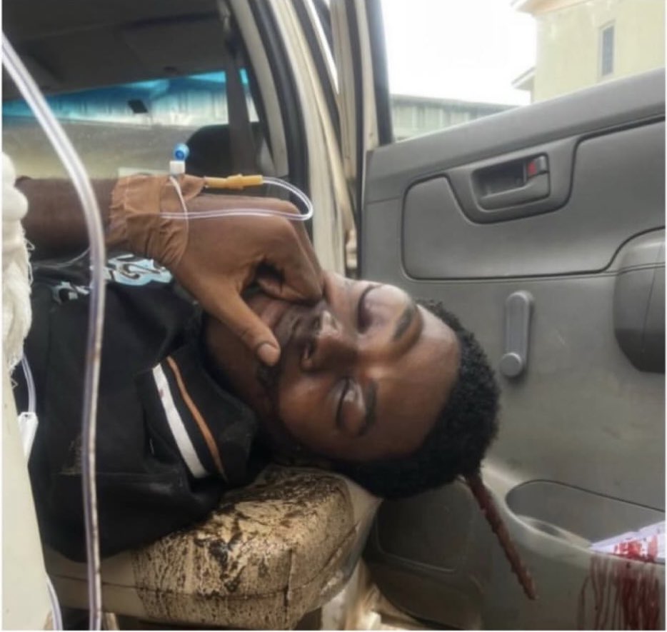 unnstudentz's tweet image. Donald, a final-year Law student of UNN Enugu campus is currently at UNTH after a tragic fall that left a rod lodged in his skull yesterday .
He fell from a balcony and was pierced with iron rods through his head.
UNTH Is Demanding N12m 
Let’s save Donald 🙏🥺