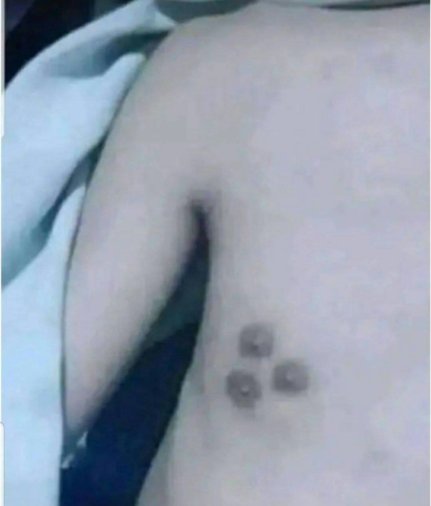 hemo_shk's tweet image. What is the diagnosis?
Associated?