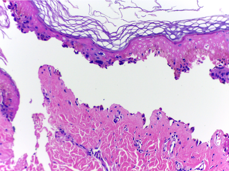 IntSocDermpath's tweet photo. Lesions induced by deodorant spray 
 
•Subepidermal blister  

•Epidermal necrosis

by @KarinaMunhoz10 

#ISDP2026Denver #dermpath #dermatology #pathology https://t.co/iP5RIKM3aN