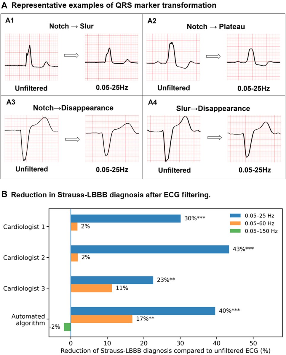 JACCJournals's tweet image. Inappropriate ECG signal filtering significantly influences the diagnosis of
Strauss-LBBB in heart failure patients. jacc.org/doi/10.1016/j.…

#EHRA26 #JACCCEP #ECG #cvEP #HeartFailure @curilakarol