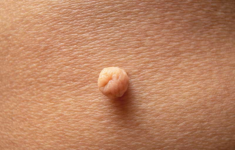 Nutri_Science_'s tweet photo. 8 signs you're chronically stressed (&amp; don't realize it):

1. Skin tags. https://t.co/OqkrbjO1ye