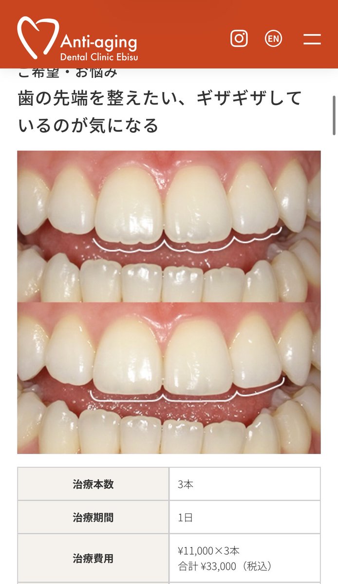 wmpmgtj's tweet photo. 歯列矯正済みなんだけどなんでか綺麗な歯並びに見えなくて悩んでて、
セラミックは反対派なんだけどこれ気になる
めっちゃ安いし少し削るだけで印象変わりそう！！
やったことある人いる？？ https://t.co/M5xA6fCWoY