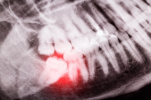 mdicasyracuse's tweet image. Tooth extraction may be needed to prevent long-term oral health issues. At Brent Bradford, DDS, we can replace the tooth with a mini implant. #syracuse #implant #dentist bit.ly/3w4D1MZ