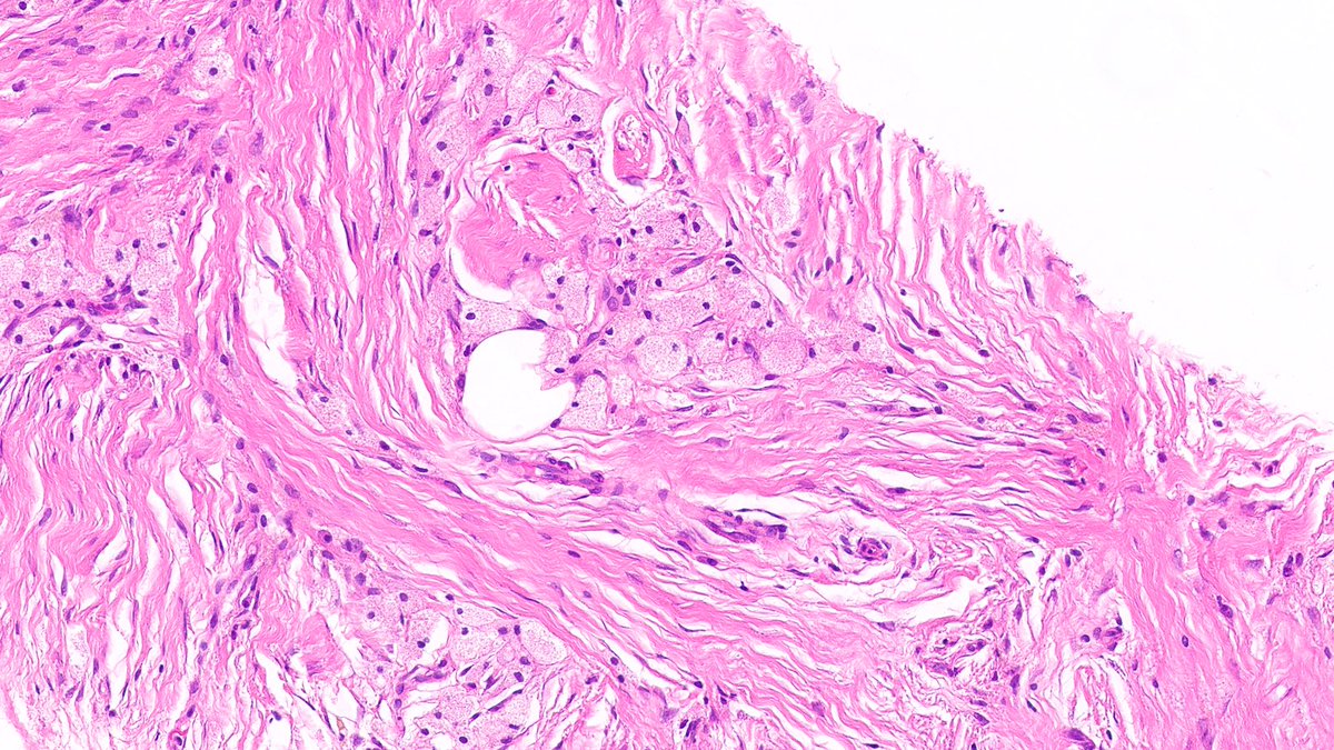 RazaHoda's tweet image. Erdheim-Chester Disease 🦛🔬

Clusters of foamy histiocytes with abundant xanthomatous cytoplasm in a densely fibrotic background.

#PathX #PathTwitter #breastpath