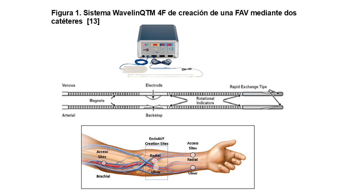 SENefrologia's tweet photo. 🆙 ACTUALIZACIÓN en #Nefroaldía @nefroaldia👇
🫀 Fístulas Arteriovenosas Endovasculares (endoAVF)  
✍️ Sagrario García Rebollo, Pablo de la Fuente Gebauer, Jorge Senkichi Uchiyamada  
🔗 https://t.co/ucTd1IL4Aa https://t.co/mcgG01OLlY
