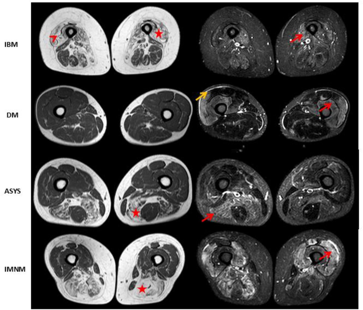 journal_nd's tweet photo. 📄 New in JND

Muscle MRI detects early, subtype-specific patterns in idiopathic inflammatory myopathies: https://t.co/PS2nfR42xX 

✔️ Distinct signatures across IBM, DM, PM, ASYS, IMNM
✔️ Correlates with muscle strength &amp; CK

#Myositis #MRI #Neuromuscular https://t.co/DSkI29UOoO