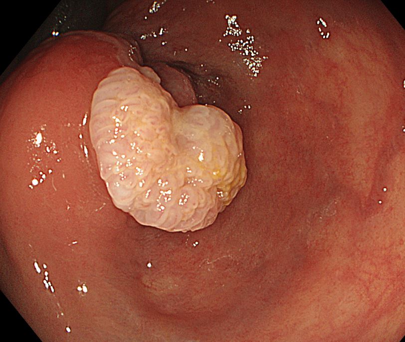 oviedendoscopia's tweet photo. Condiloma anal en VIH con displasia de alto grado, VPH÷ https://t.co/yRE6mg20gC