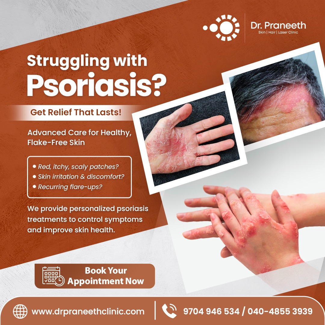 DrPraneethKumar's tweet image. Struggling with psoriasis? 🌿
Get expert care for relief from itching, redness &amp;amp; flare-ups.
Book your appointment today!
📞 9704946534
#Psoriasis #SkinCare #HealthySkin #Dermatology #SkinTreatment #Hyderabad #ClearSkin #SkinClinic #PsoriasisRelief #DrPraneethClinic