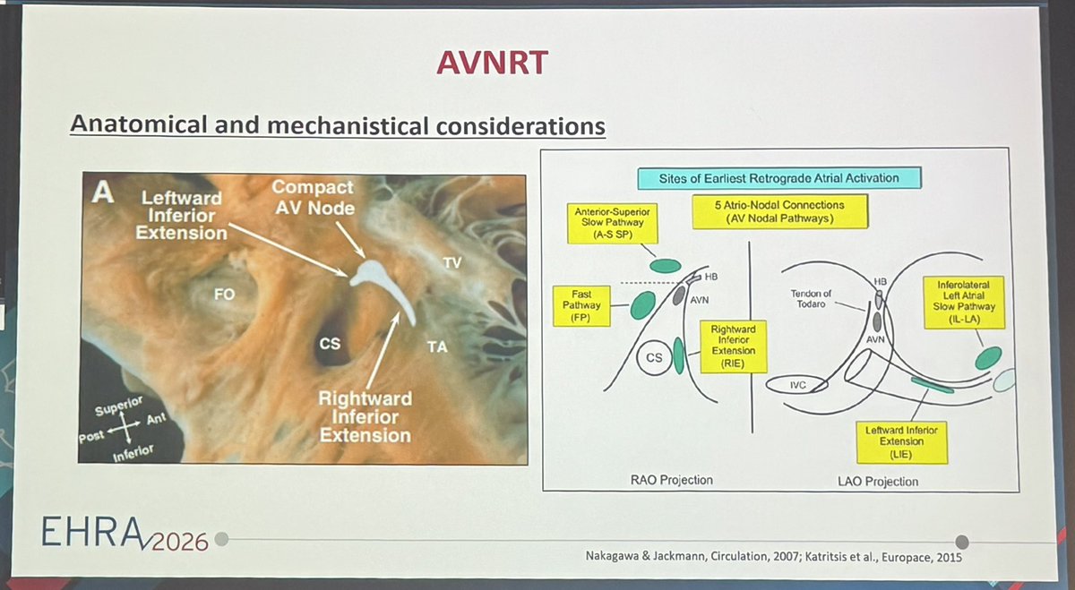 Dr_Ahmed_Ammar's tweet image. Back to Basic Electrophysiology

Nice educational case and discussion of different types and rare forms of AVNRT by Dr Christiane Jungen at #EHRA26

#EPeeps