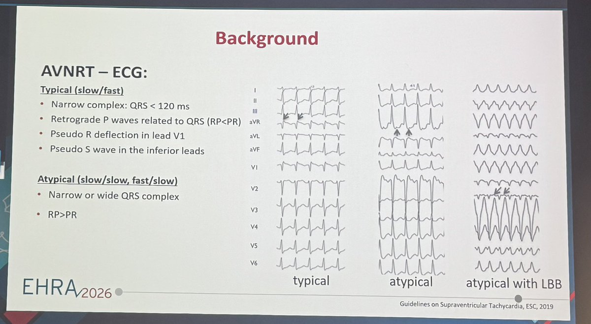 Dr_Ahmed_Ammar's tweet image. Back to Basic Electrophysiology

Nice educational case and discussion of different types and rare forms of AVNRT by Dr Christiane Jungen at #EHRA26

#EPeeps