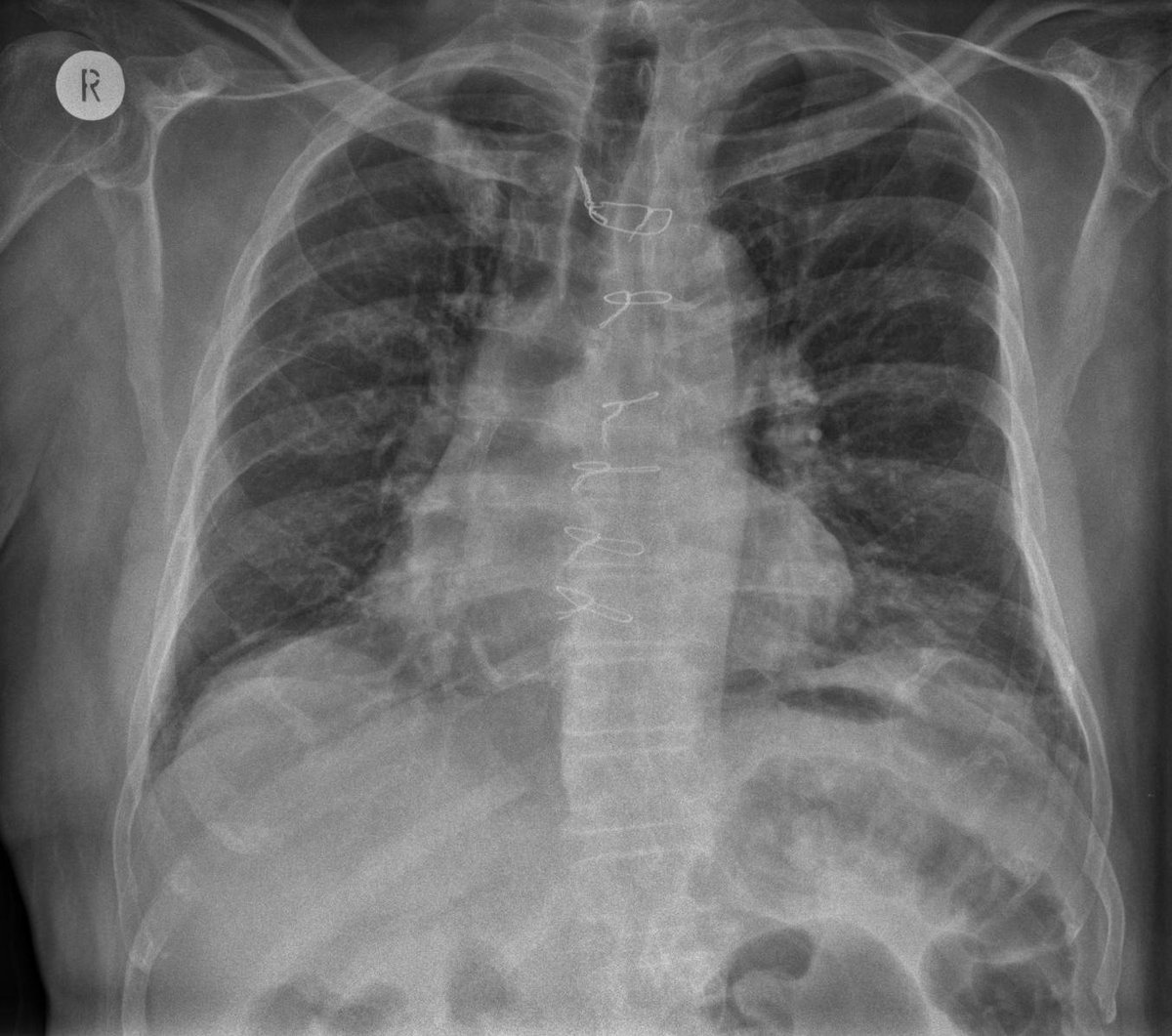 EuroRespSoc's tweet image. It's time for this week's #radiology image challenge!

Case: 61-year-old male smoker with a history of ischaemic heart disease &amp;amp; previous coronary artery bypass grafting presenting with breathlessness

1. What is the main abnormality?

Select your answers: bit.ly/422cxHJ
